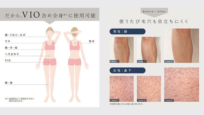 LINKA フレアタッチ プロ リンカ 脱毛器 脱毛 光美容 エステ 美顔器 美容機器 美容 美肌 ボディケア VIO 顔 脇 ワキ ヒゲ 家電 美容器 