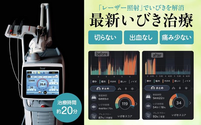 いびき治療利用券（１回） ANBV001